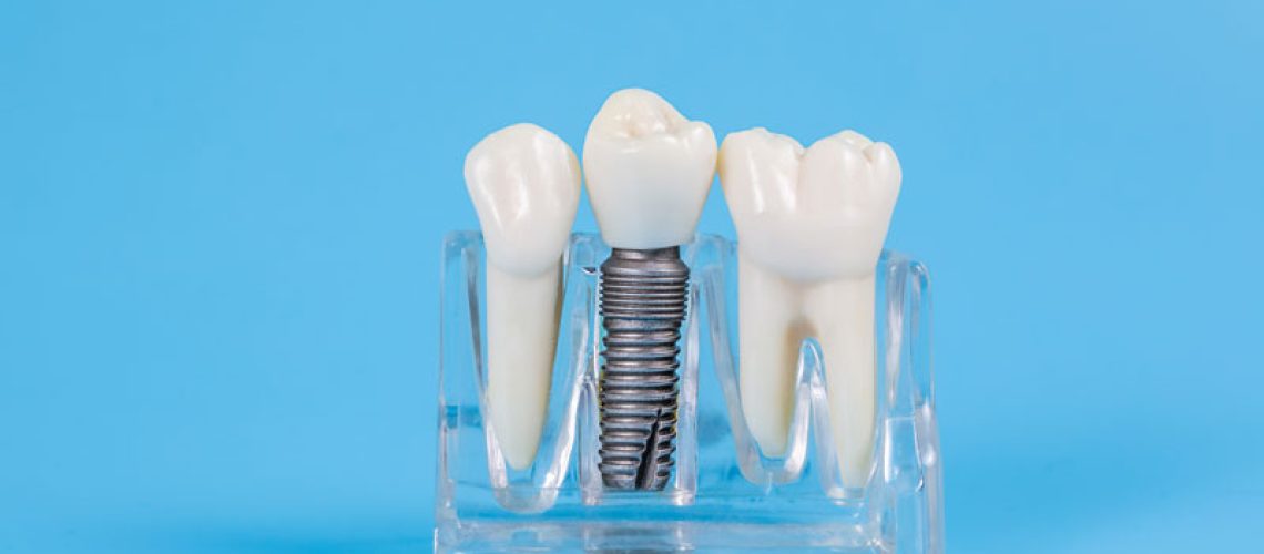 a model of a single dental implant and post.