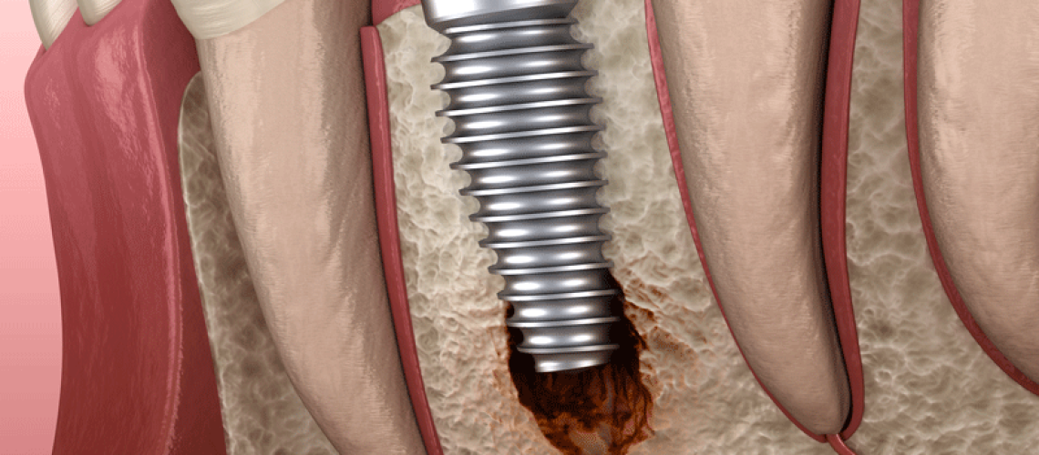 a single dental implant being affected by peri-implantiits