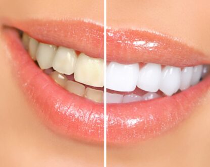 I Want to Whiten My Smile; Should I Ask My Dentist About It First?