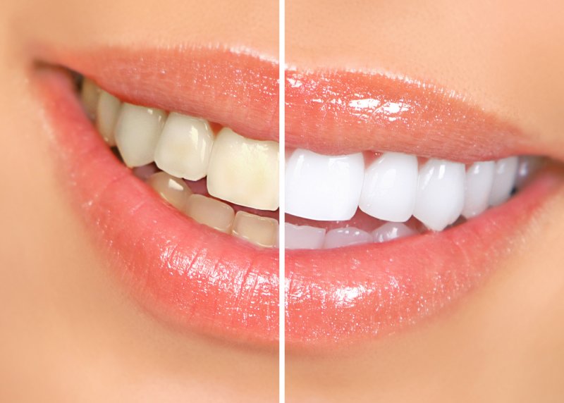 I Want to Whiten My Smile; Should I Ask My Dentist About It First?