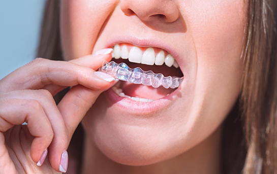 Woman placing an Invisalign clear aligner over her teeth