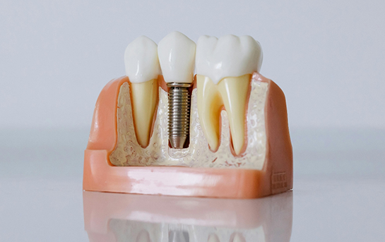 Model of a dental implant in the jawbone