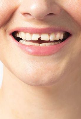 Repair cavities and broken teeth near Windermere