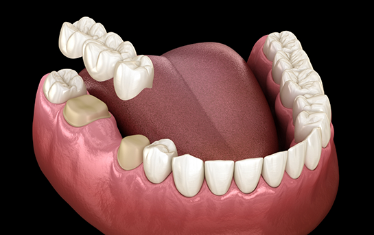 Illustration of a dental bridge being placed over two teeth to fill the gap between them
