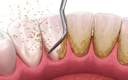 Illustration of a dental scaler clearing tartar buildup from the teeth