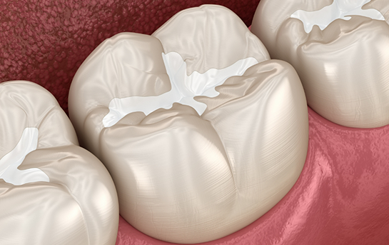 Illustration of teeth with white fillings