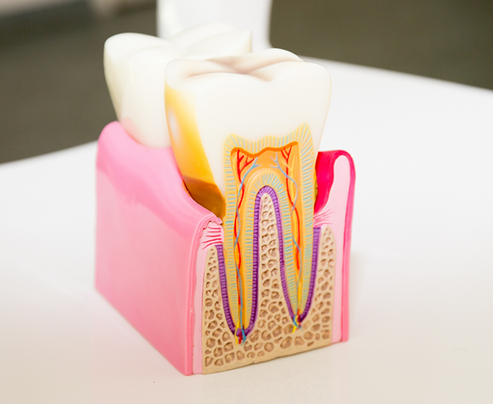 Root Canal Treatment