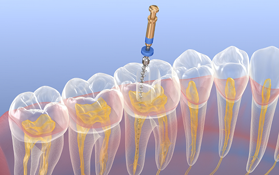 Illustration of a thin dental instrument treating the inside of a tooth