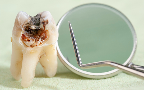Dental mirror next to a severely decayed tooth after extraction