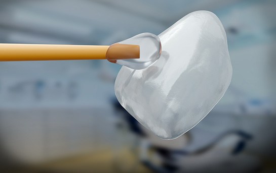 Veneer being grabbed by clear cement