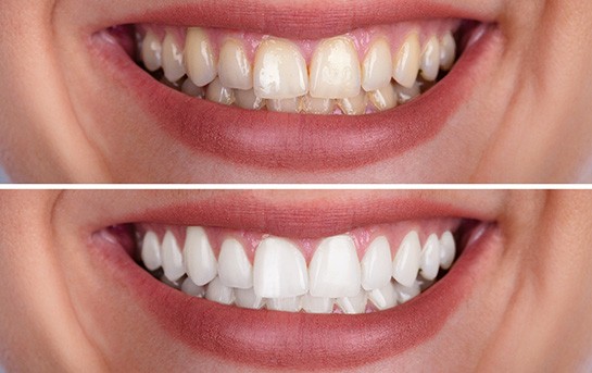 if you have deep stains or tooth discoloration and healthy teeth, you may be a good candidate for teeth whitening