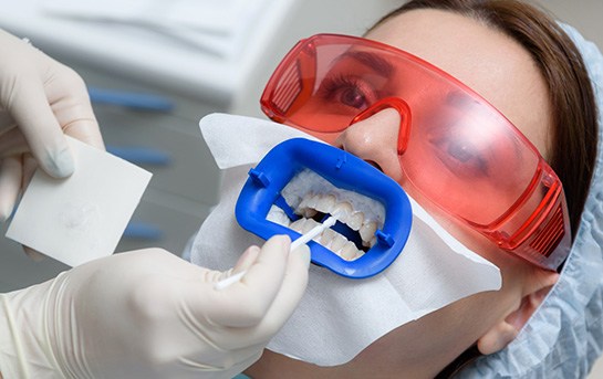 Teeth whitening works by applying powerful gels to the surface of the teeth