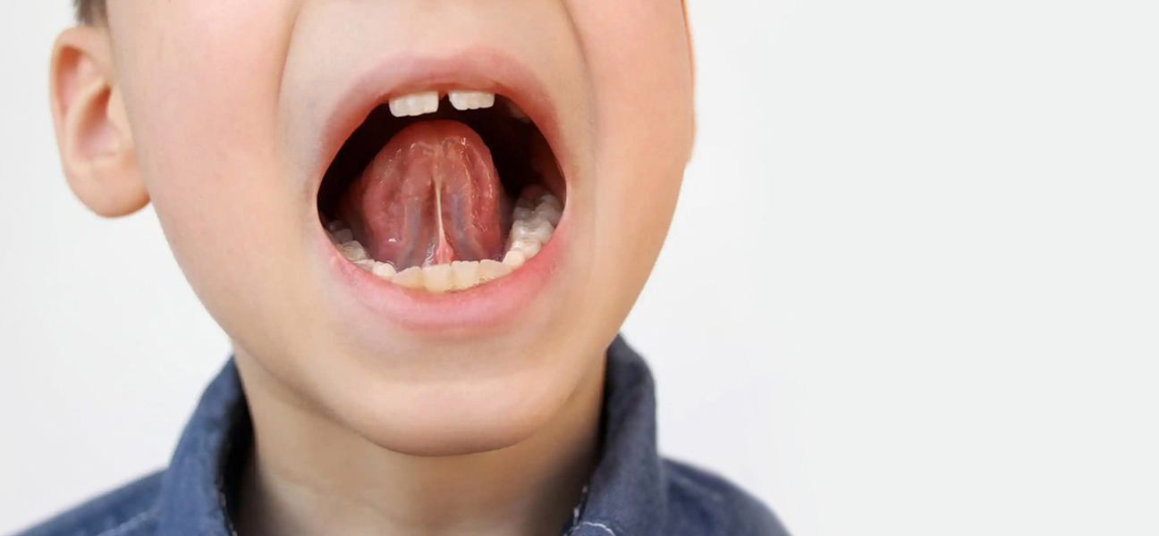 Frenum and Frenectomy: All You Should Know