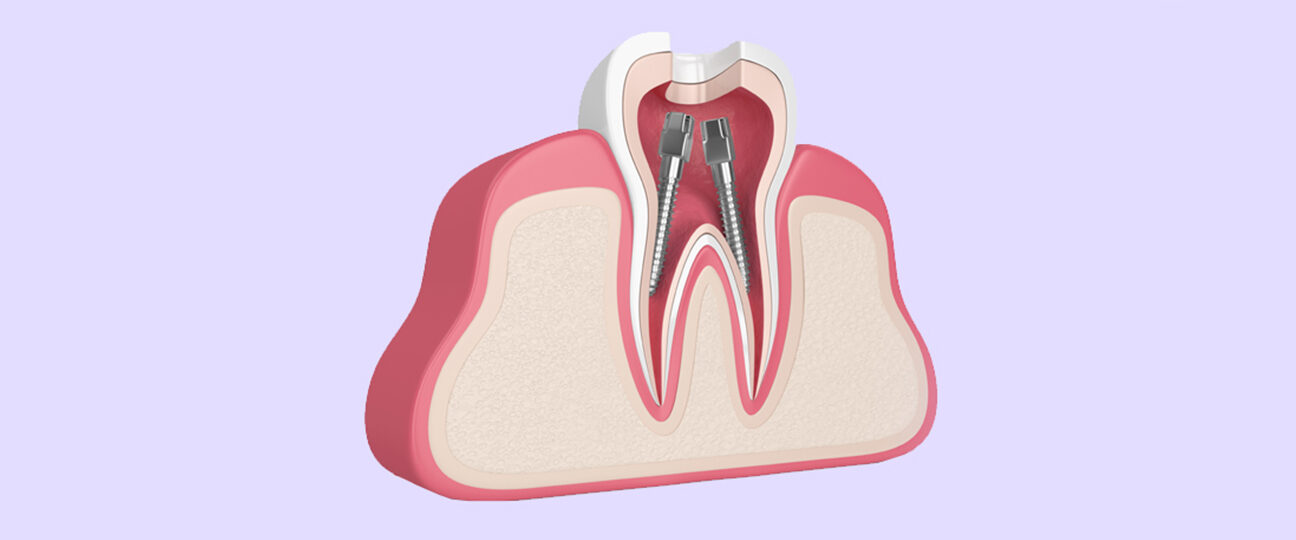 Root Canal Therapy Explained