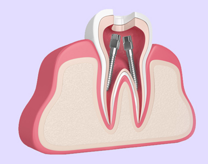 Root Canal Therapy Explained 