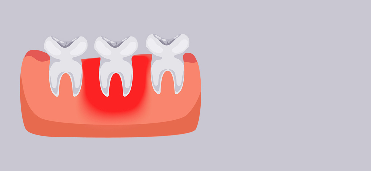 How Long Can You Keep Your Teeth With Periodontal Disease?