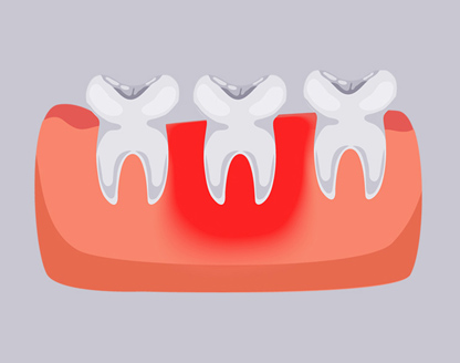 How Long Can You Keep Your Teeth With Periodontal Disease? 