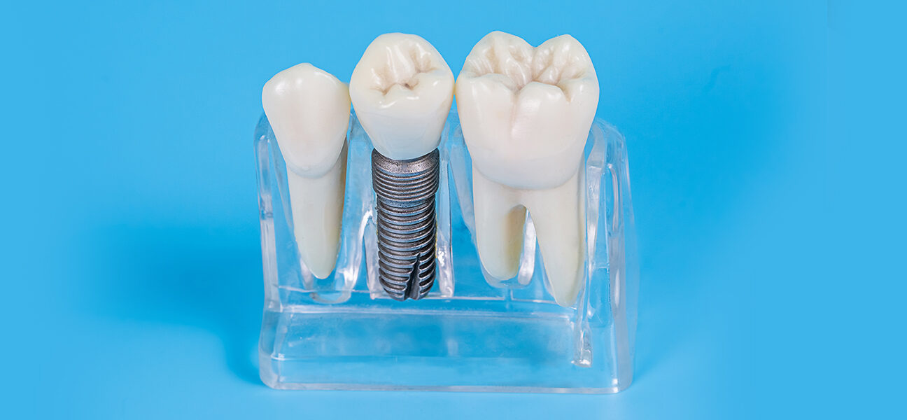 How Do Dental Implants Work?