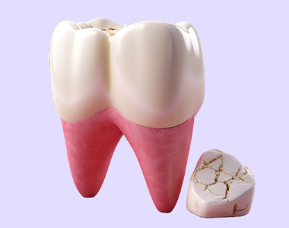 Broken Wisdom Tooth – Is It Considered An Emergency? 