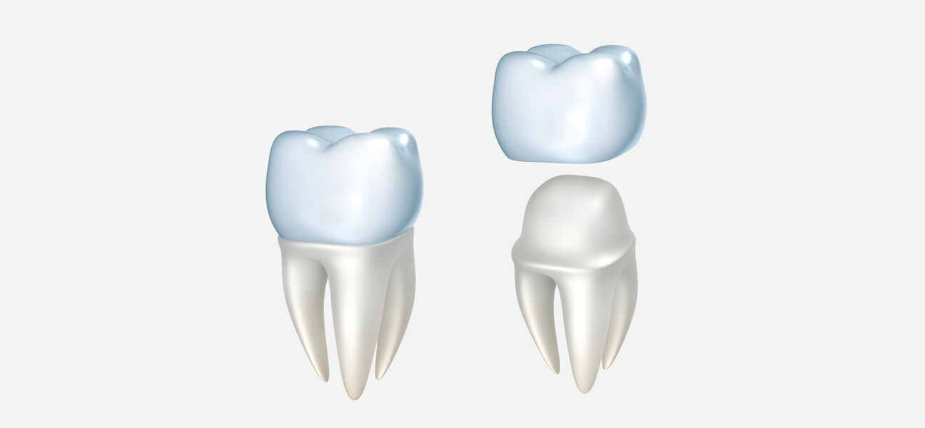 What Is the Procedure for Getting Dental Crowns, and How Long Does It Take?