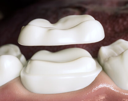 Is there any Alternative to Dental Crown?