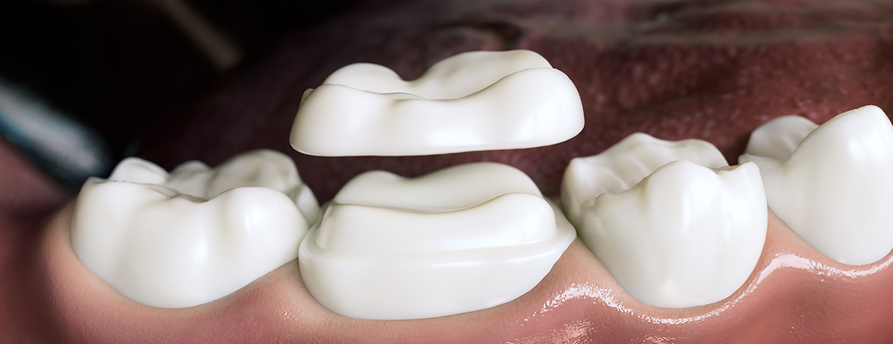 Is there any Alternative to Dental Crown?