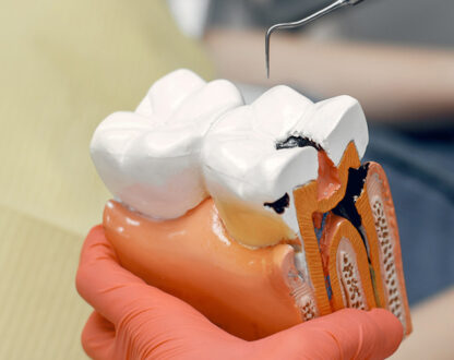 How Long Does It Take To Do A Root Canal?