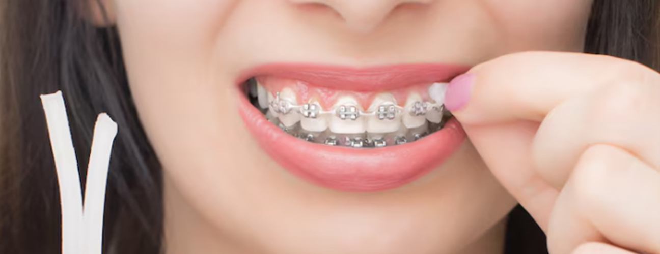 What Is Dental Wax, And How Can You Use it With Braces?