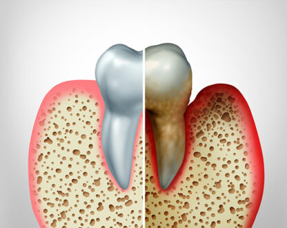 Stop Your Receding Gums From Getting Worse With These 7 Easy Methods!