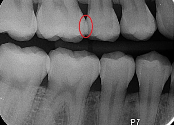 phocal Therapy