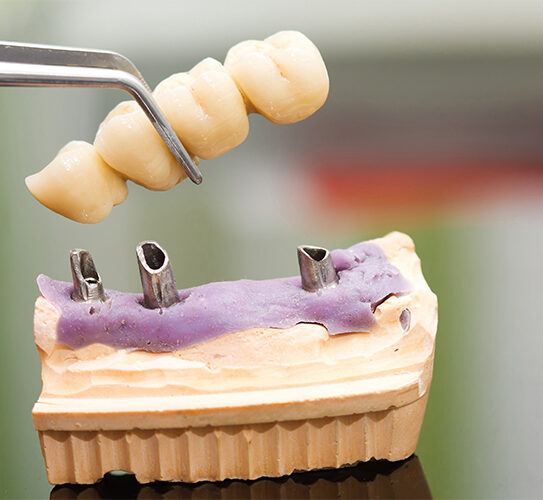 Dental Bridges