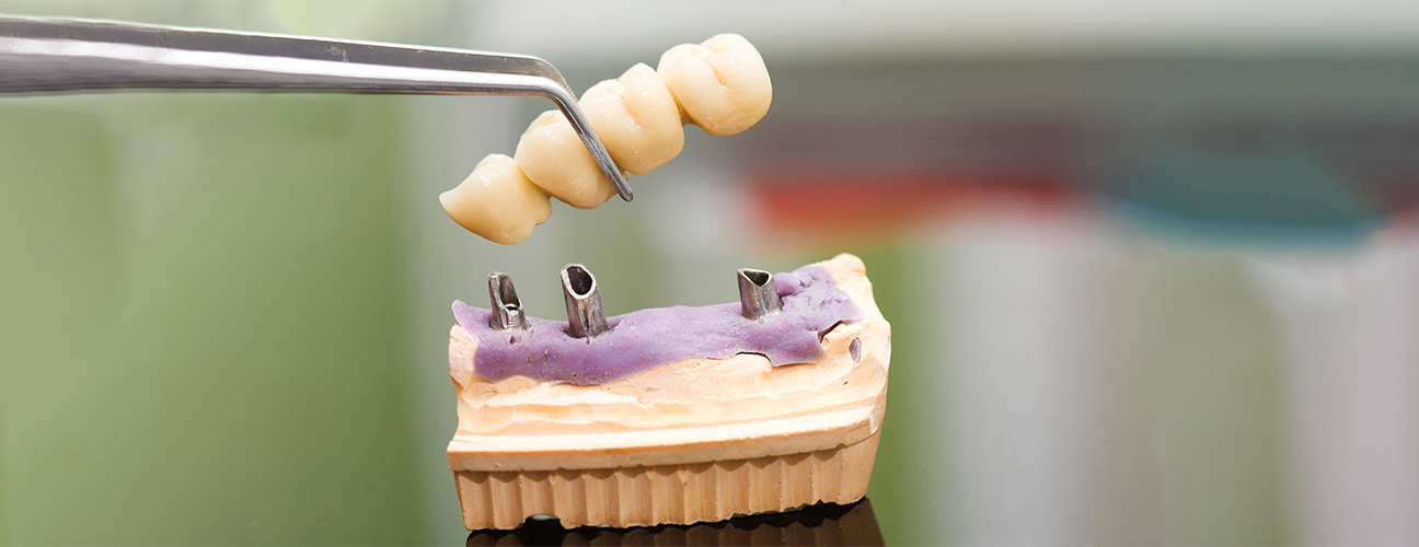 Dental Bridges