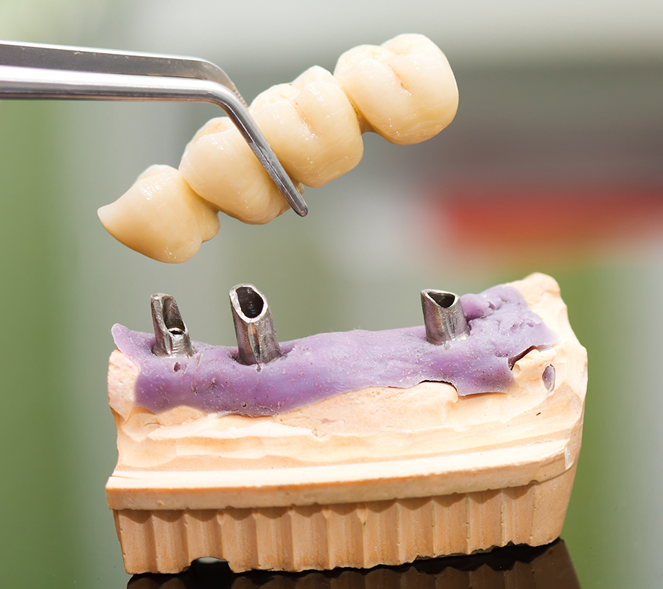 Dental Bridge