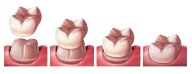 Dental Crowns