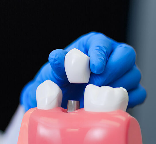 Dental Implant