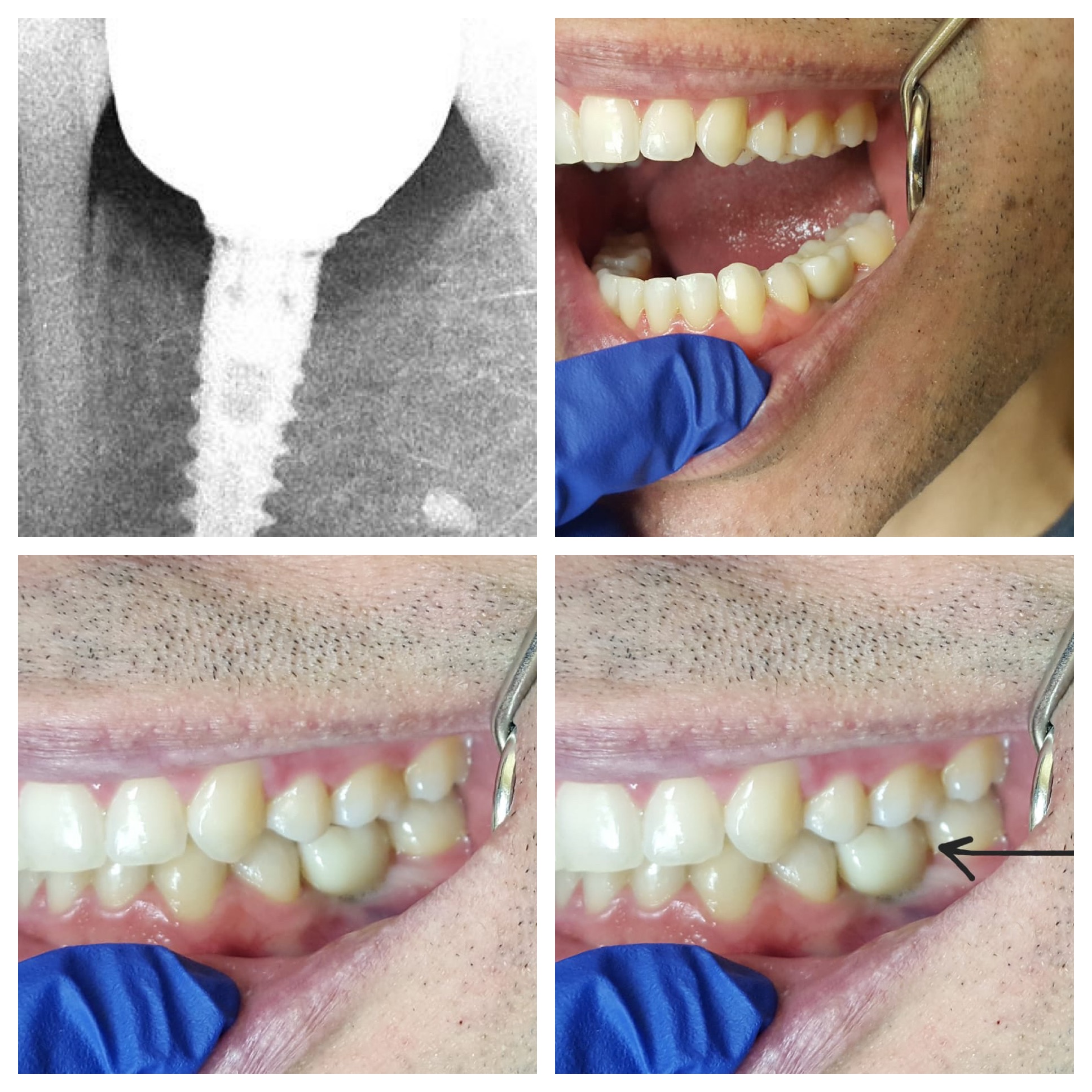 Dental Implants