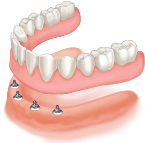 Dentures Sugar Land