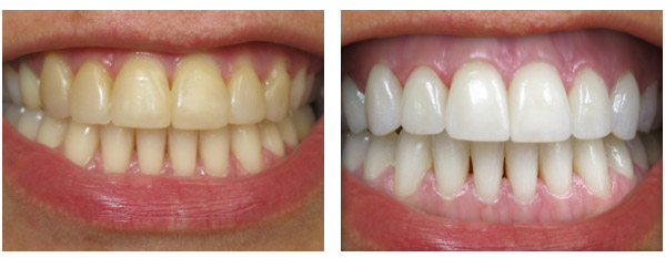 Before After Teeth Whitening