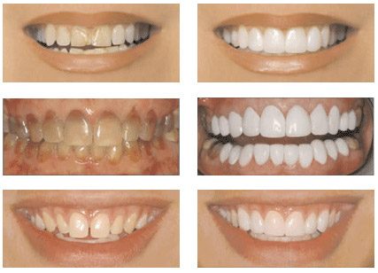 Before After Veneers