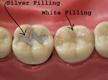 Bonding And White Fillings