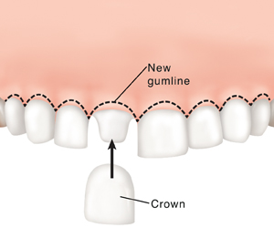 Crown Lengthening