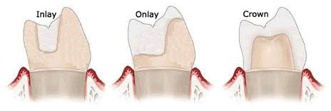 Inlays and Onlays