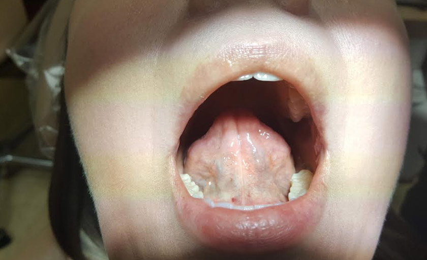 Frenectomy Before