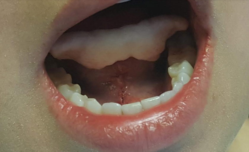 Frenectomy After