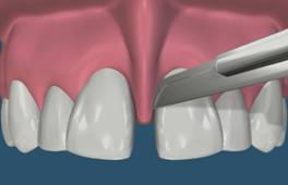 Frenectomy