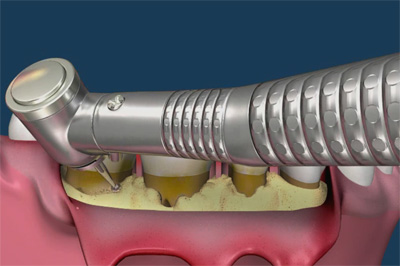 Osseous Surgery