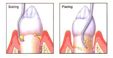 Root Planing