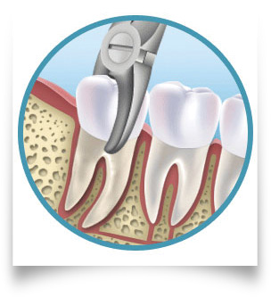 Tooth Extractions