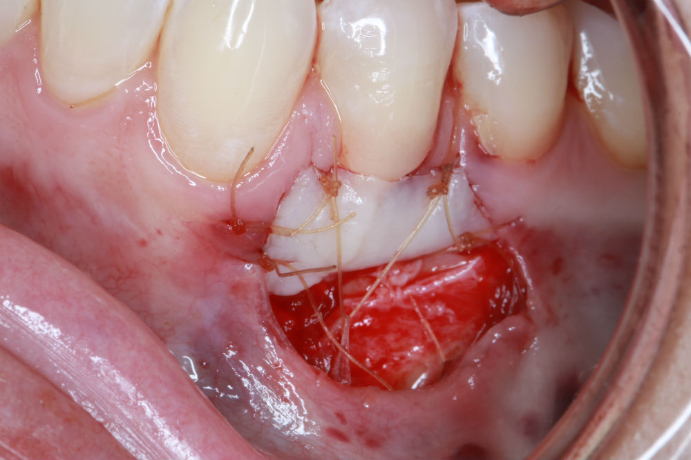 Gingival Graft Procedure