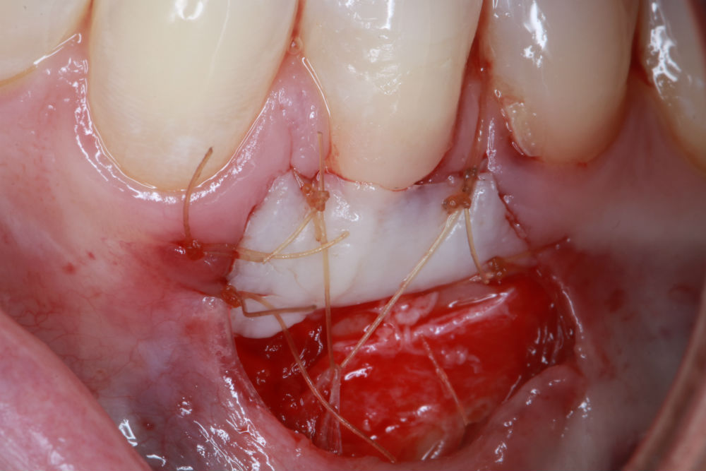 Gingival Graft Procedure